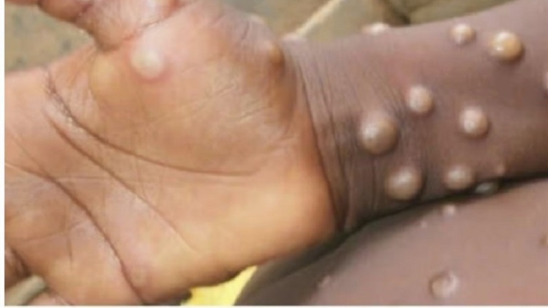 サル痘の発疹症状