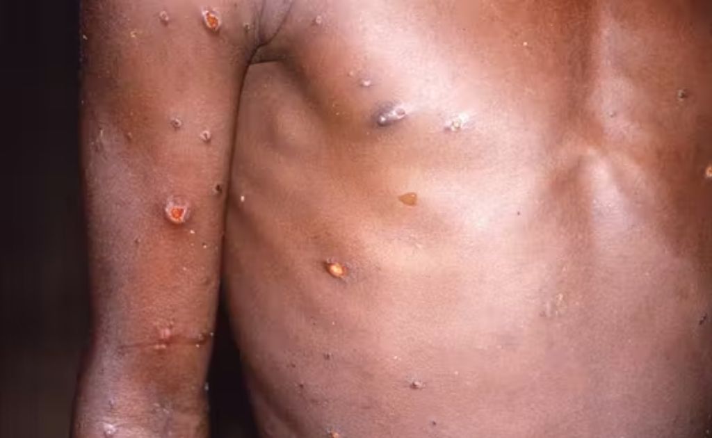 サル痘の発疹症状